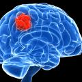 Image - Discovery of biomarker offers hope for brain cancer patients